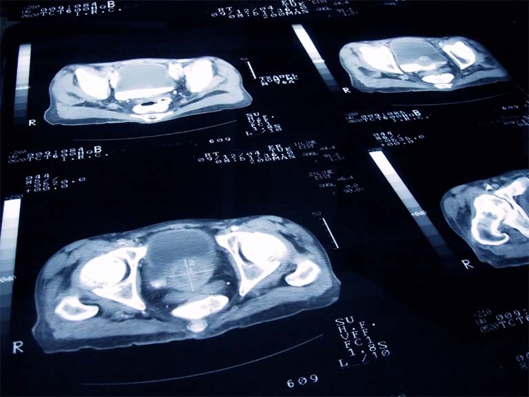 Qual o tratamento escolher para o câncer na próstata?