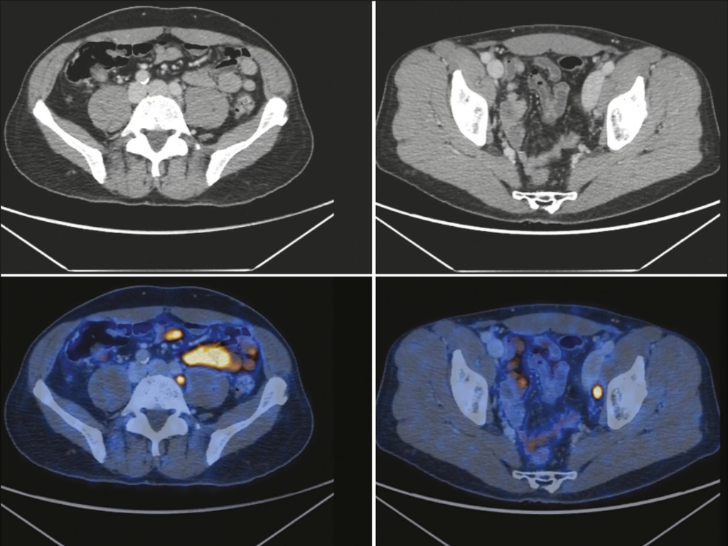 PET CT PSMA: A Evolução no Estadiamento
