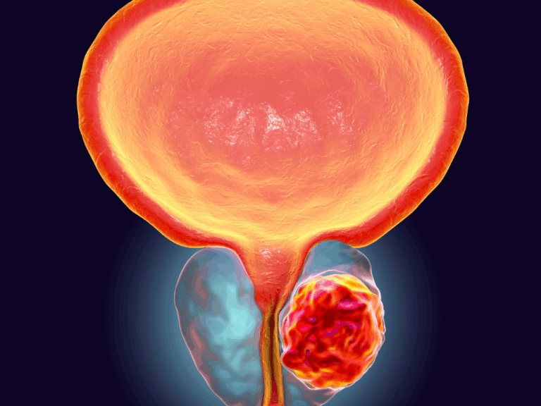 Câncer de Próstata Gleason 7, tem cura?