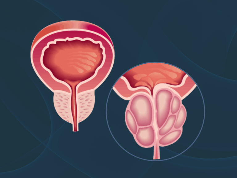 O que você precisa saber sobre o HOLEP