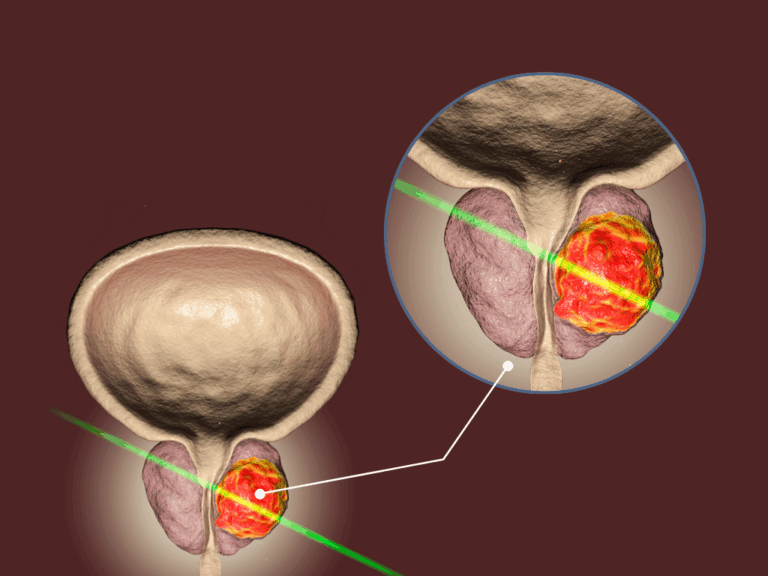 HOLEP: tratamento moderno e eficaz
