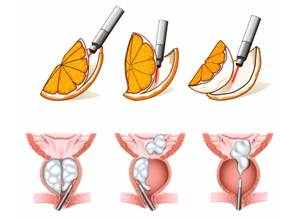 Cirurgia HoLEP